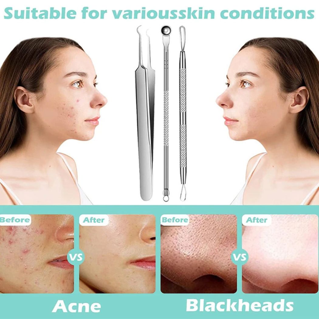 Henvivi™ Professional Stainless Steel Blackhead Acne Removal