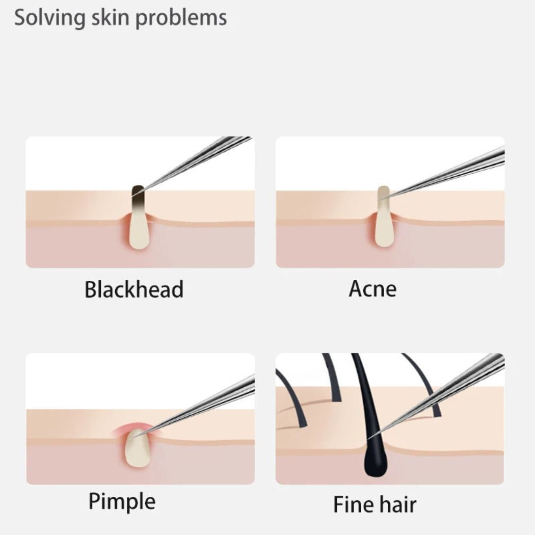 Henvivi™ Professional Stainless Steel Blackhead Acne Removal